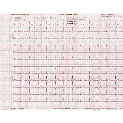 Bionet ECG Paper for Cardiocare 2000, 3000