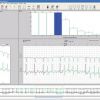 Burdick Vision Holter Analysis System