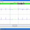 Forest Medical Trillium Silver Holter Analysis Software
