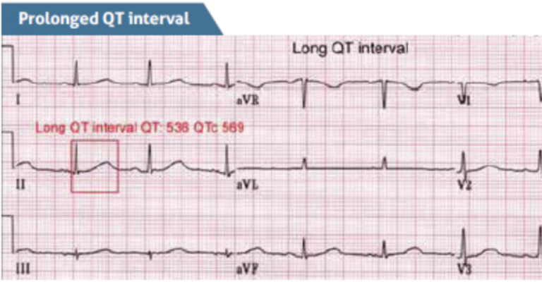 Синдром удлиненного qt на ЭКГ. Синдром удлиненного интервала qt на ЭКГ. Удлиненный интервал qt на ЭКГ что это такое. Интервал qt на ЭКГ.
