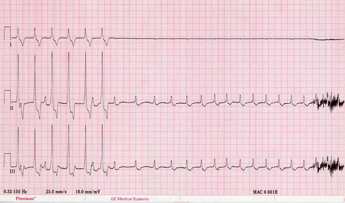 non interpretive ekg example