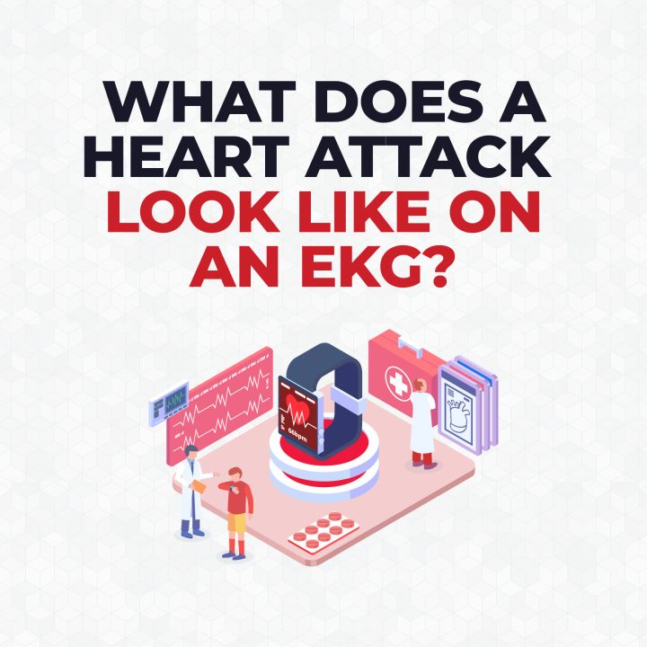 What does a Heart Attack look like on an EKG? CardiacDirect
