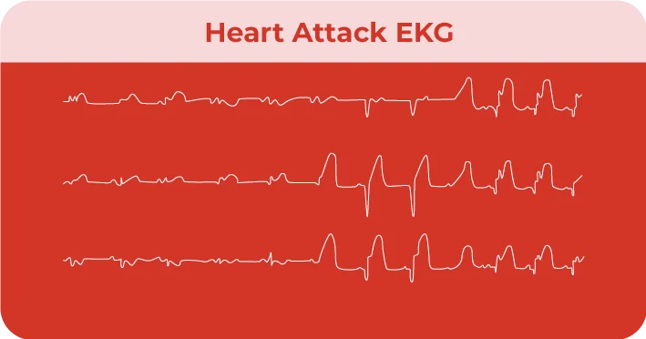 Heart-attack-EKG