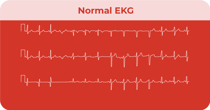 Heart Attack EKG Can An EKG Detect A Previous Heart 57 OFF