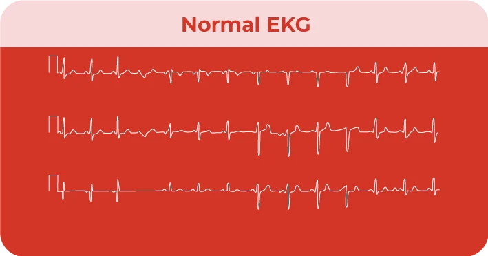 Normal-EKG-graphic