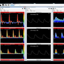 Huntleigh Dopplex Vascular Reporter Software