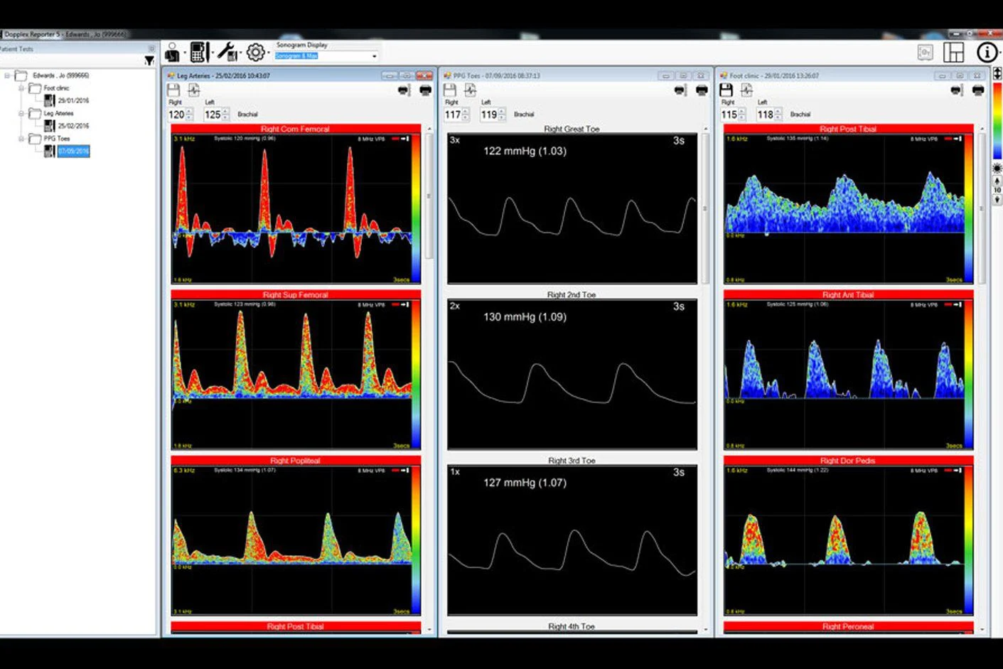Huntleigh Dopplex Vascular Reporter Software